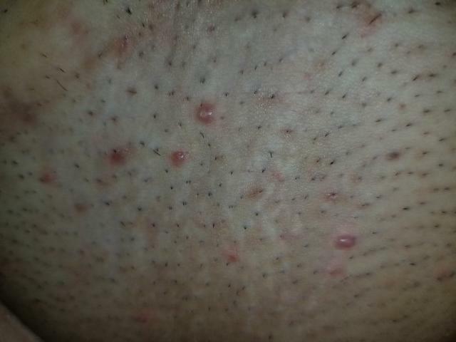 Razor Burn Bumps Or Std