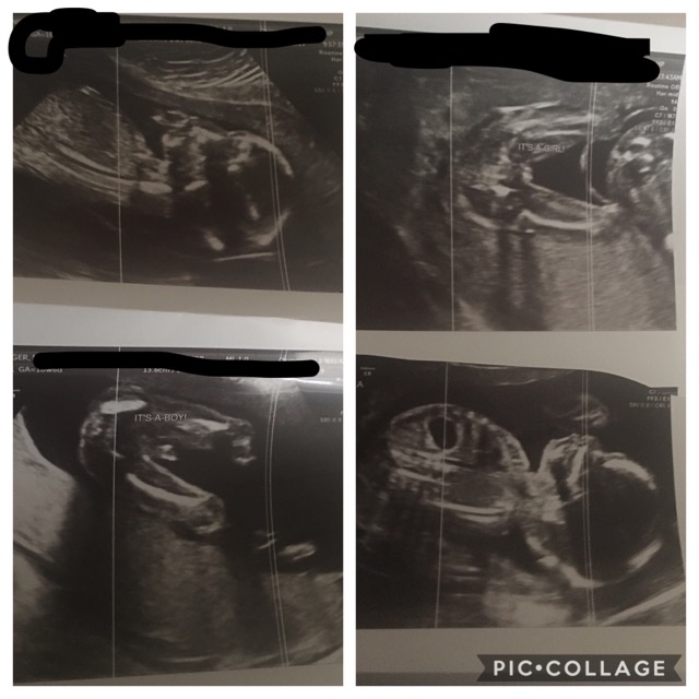 Anatomy scan ️ the twins are perfect! Now I actually have proof that I