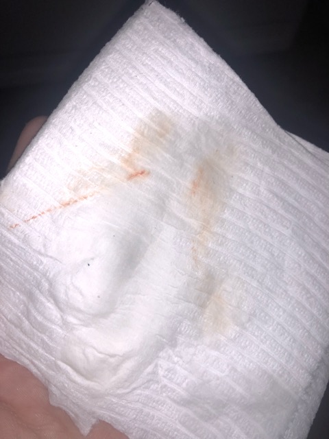 Implantation Bleeding I Am 6 7 Dpo I ve Been Experiencing Light 