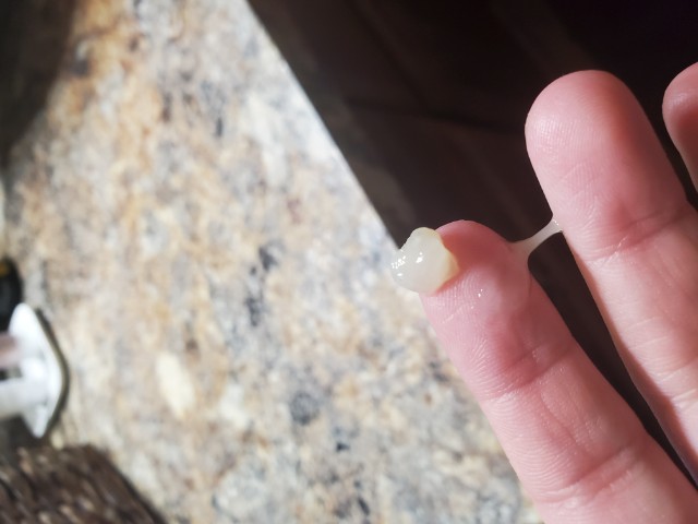 Sorry Tmi But I Went To Bathroom And Had This I m 17weeks And A Day 