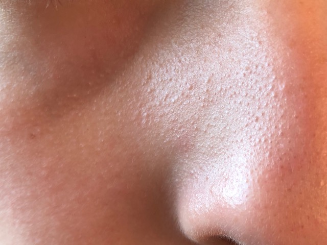 Anyone Know How To Get Rid Of Bumps On Nose Area Glow Community