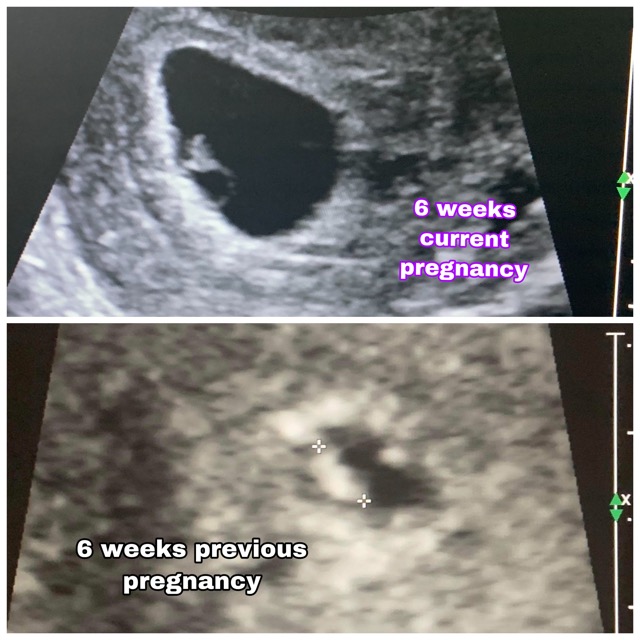 6 week ultrasounds from this pregnancy and the last that ended in(01)